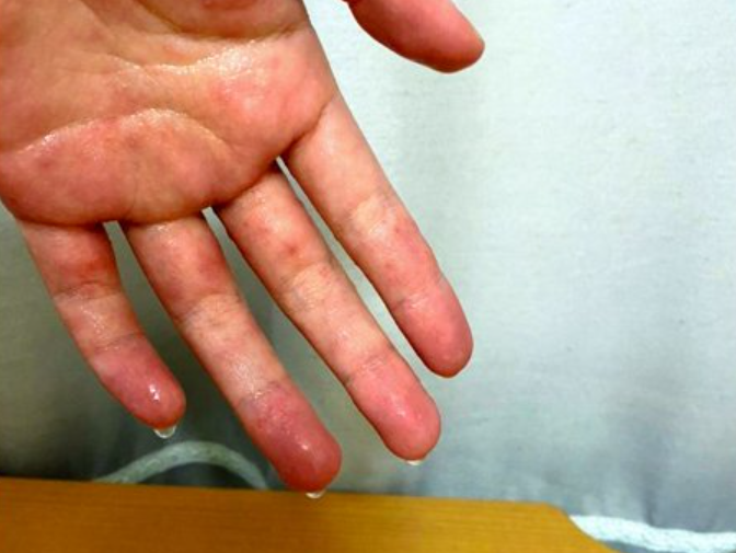 백년뒤앤 다한증 전용 영양제 스웨트린 정 먹고 손 땀 사라진 찐후기