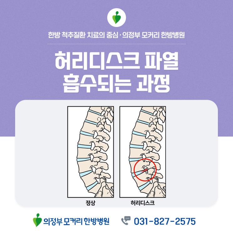  의정부한방병원 허리디스크 파열, 흡수되는 과정