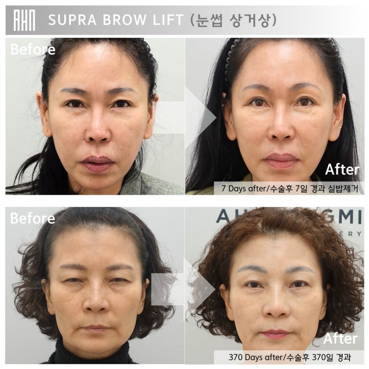  눈썹 거상 수술 후 30일 경과, 1년 경과