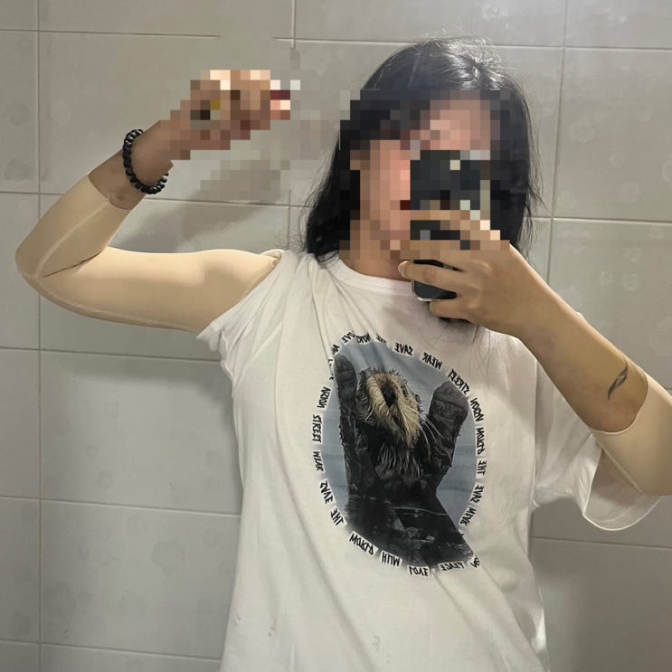  지방흡입10일차후기,대전팔뚝지방흡입,지방흡입후기,대전지방흡입비용,팔뚝살빼는법,지방흡입장단점