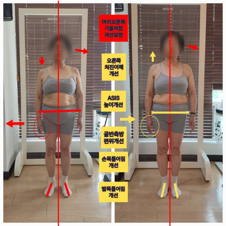  부산 동래 척추관협착증 왕복3시간 거리 회원님 허리통증 개선 후기