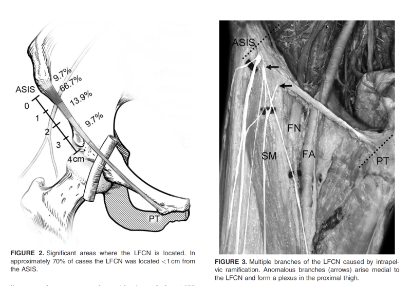바깥 허벅지가 무뎌요, 내 살 같지 않아요, 따가워요 : LFCN (Lateral Femoral Cutaneous Nerve ...