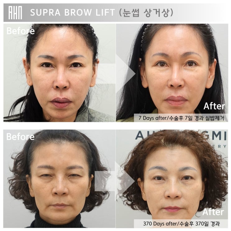  눈썹상거상이 필요한 이유 눈썹하거상의 부작용. 안성민 원장님