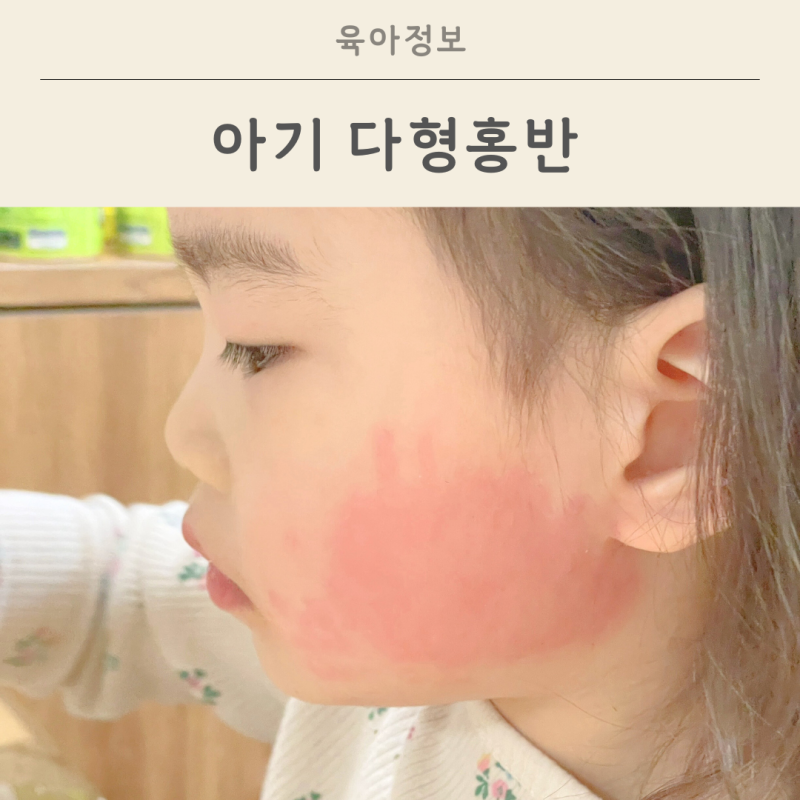 아기 다형홍반 원인 유아 알레르기와는 달라요