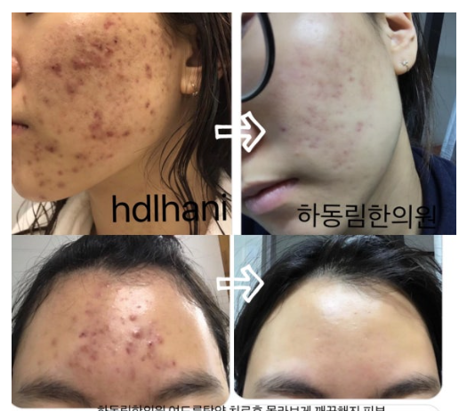  여드름,폐풍분자의 증상, 치료 방법, 사례 모음