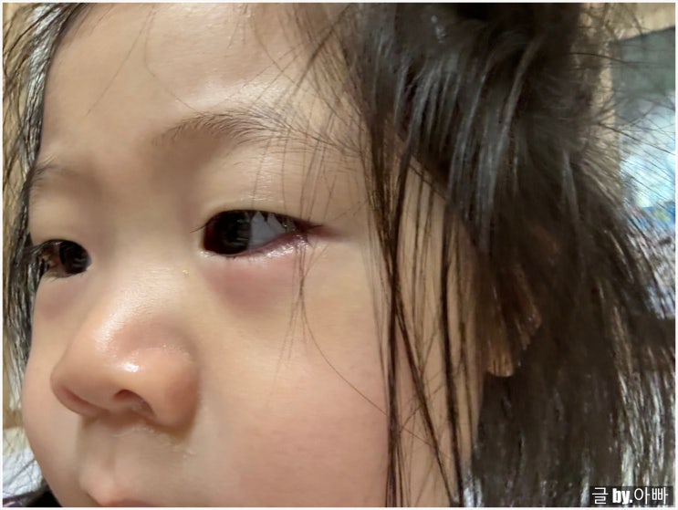  두돌 아기 눈 결막염 특이했던 원인