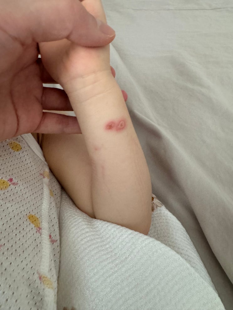 닿기만 해도 물집이 생기는 공포의 화상벌레 증상과 치료방법