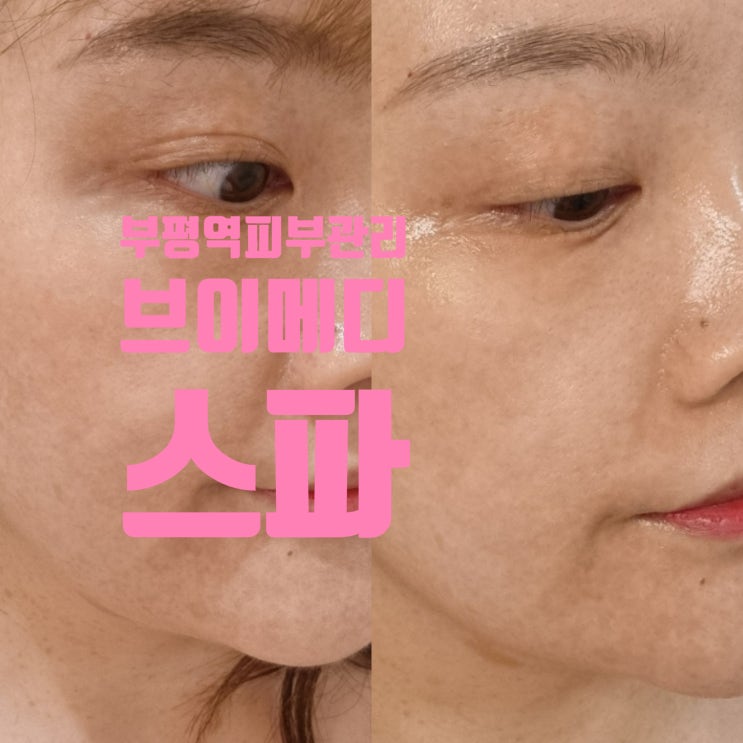  부평역피부관리 추천  브이메디스파에서 MTS 엑소좀 관리 후기