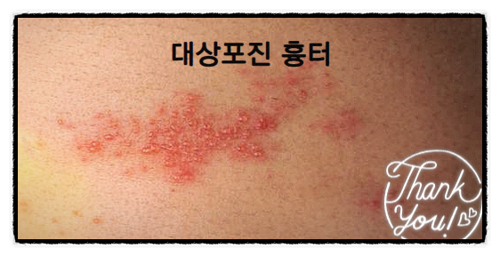  대상포진 흉터 관리하기