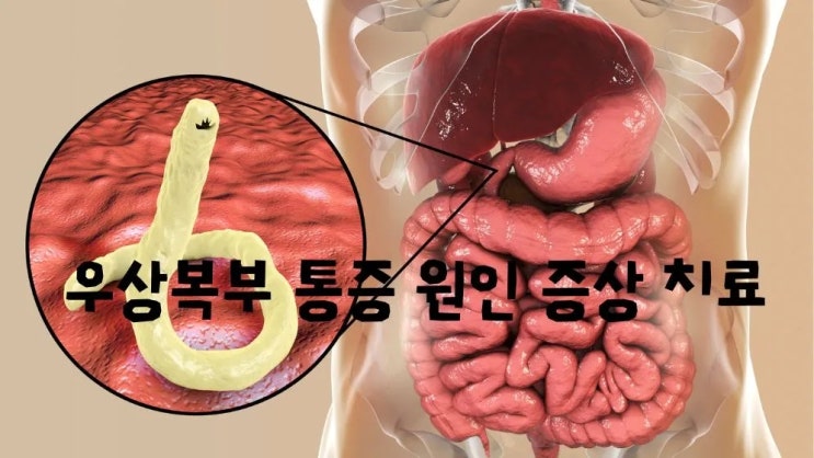  십이지장 게실염은 무엇? 우상복부 통증 원인 증상 치료