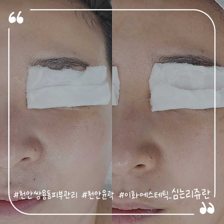  천안쌍용동피부관리 천안윤곽관리추천 이화에스테틱 심는리쥬란 내돈내산후기