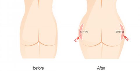  요즘 유행하는 필러 부위