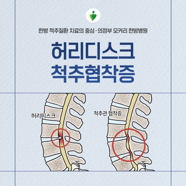  허리디스크, 척추협착증으로 진행을 막으려면
