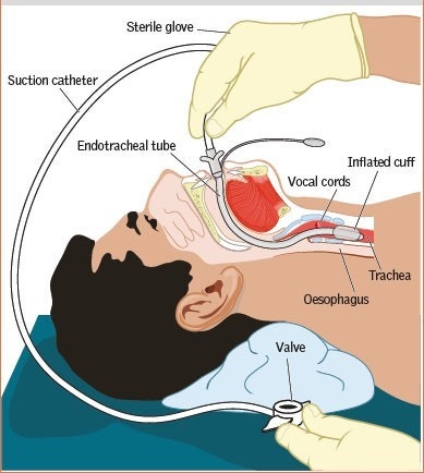 흡인 간호(Suction) 목적 및 준비물품과 절차 주의사항 : 네이버 블로그