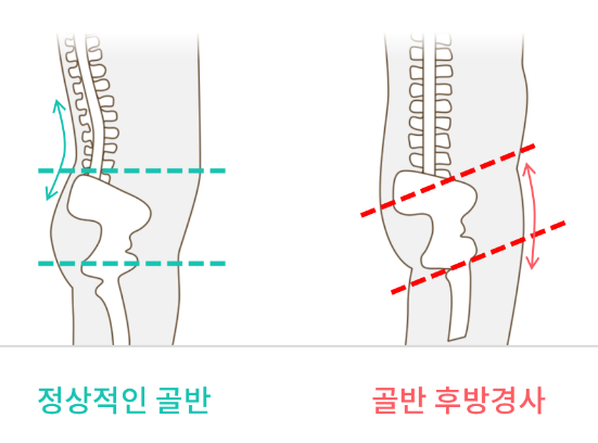  [신내동필라테스] 골반 후방경사의 원인과 필라테스 처방