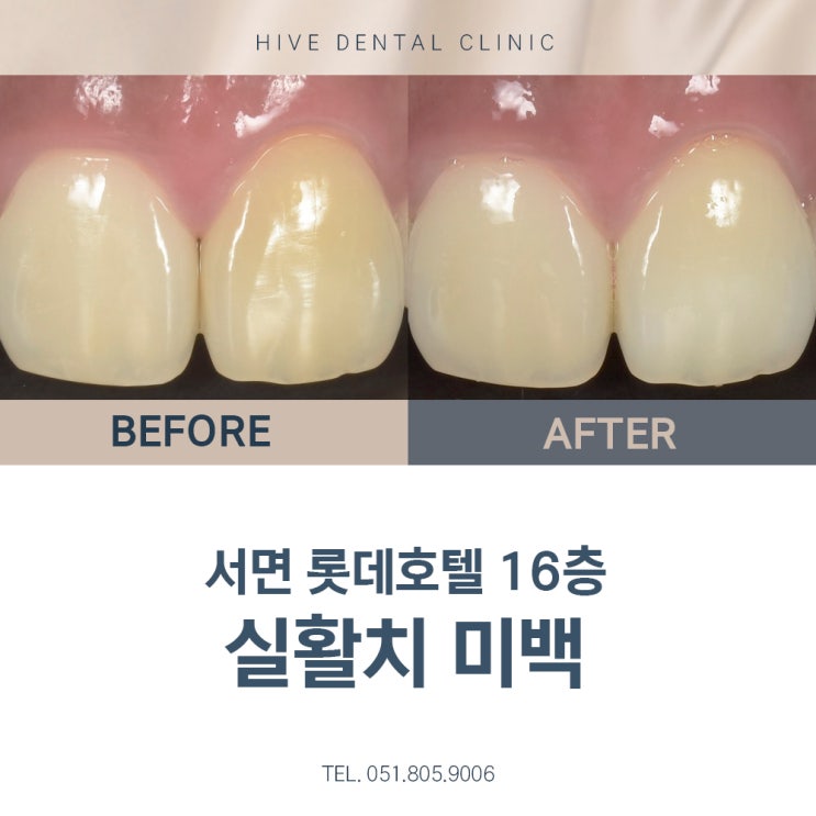 부산<b>서면</b><b>치과</b> 어둡게 변한 치아는 실활치<b>미백</b>