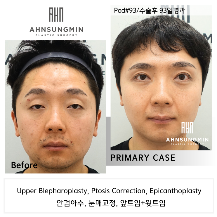  20대 남성 안검하수 증세와 눈매교정 수술 후 3개월 경과