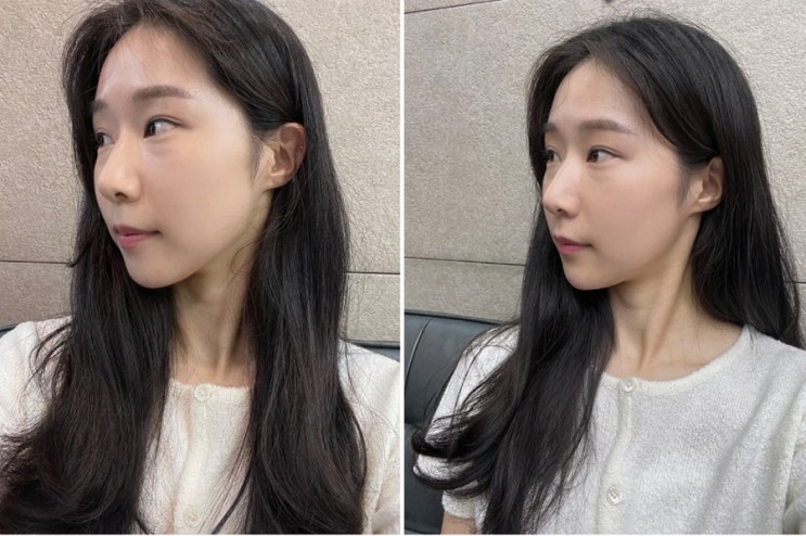  구월동 피부과에서 턱 필러와 보톡스 맞고 일주일차