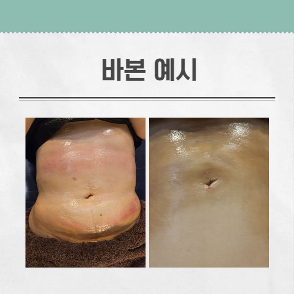  복부지방흡입 후 바본 관리법. 10년 차 전문가가 알려주는 3단계 케어