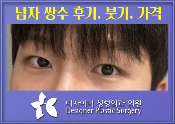  남자 쌍수 후기와 붓기, 가격까지 한눈에!