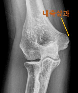  광주통증의학과 골프엘보 스테로이드 주사 맞아도 재발?