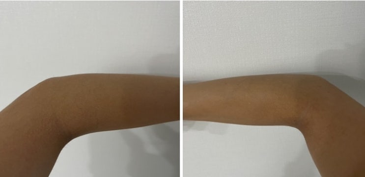  서울대입구 역 화이트태닝, 몰디브태닝 1회 후기