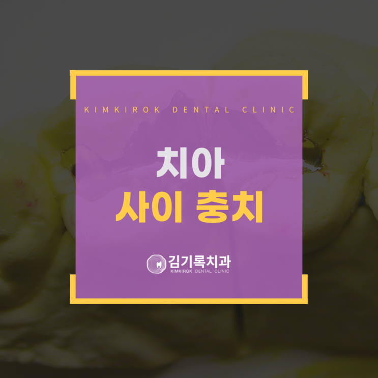매탄동진료잘하는치과 치아 사이에 충치가 생겼을 때는 어떻게 치료할까