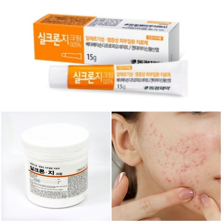  실크론지크림 여드름 피부 후기 (가격, 부작용, 주의사항)