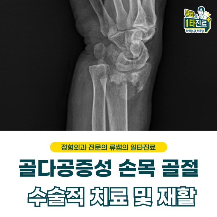  골다공증 골절, 손목골절 수술 치료 이후 재활 방법 (의사작성)