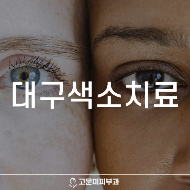  대구색소치료 기미, 잡티 등 색소를 효과적으로 제거하는 레이저 헐리우드 스펙트라