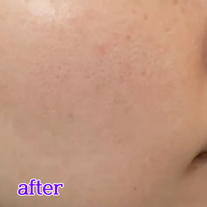 코 피지 녹이기 쉽게