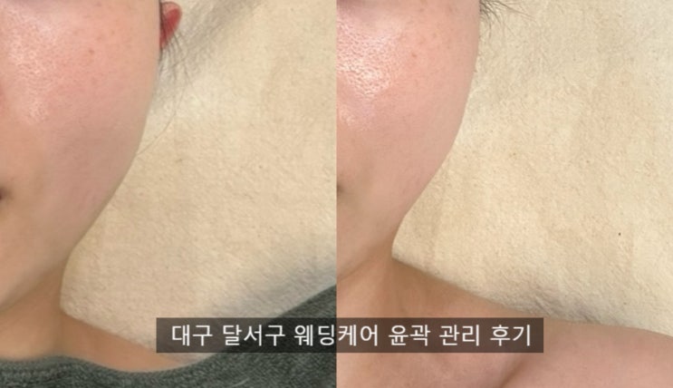 달서구 피부관리 웨딩 윤곽 잘하는 진스케어