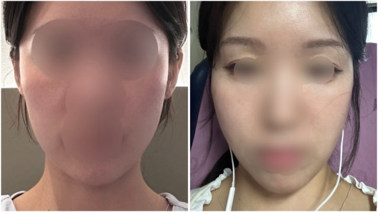 영등포 피부과 추천ㅣ볼링크(볼뉴머+슈링크) 리프팅 후기 효과,통증,전후사진