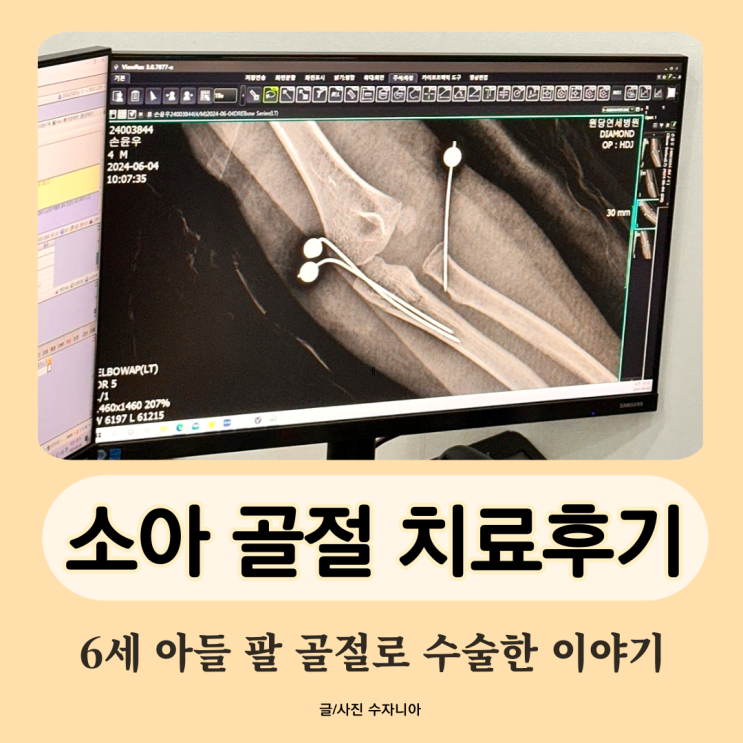  6세 소아 팔 골절::의료파업::원당연세병원에서 수술했어요.