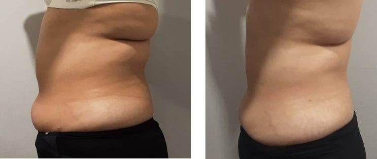  평촌람스다이어트 6주차 후기, 눈바디 체중변화, 멍붓기 솔직후기