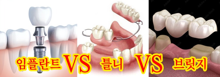  평택 임플란트 틀니 브릿지 놓고 뭘해야할까?