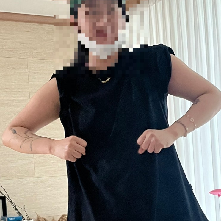  대전팔지방흡입 ㅣ 팔지방흡입2주차후기,대전지방흡입가격,지방흡입후실밥제거