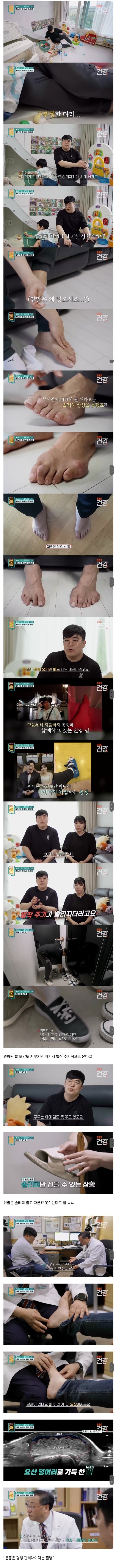  30대 통풍 환자의 발 상태