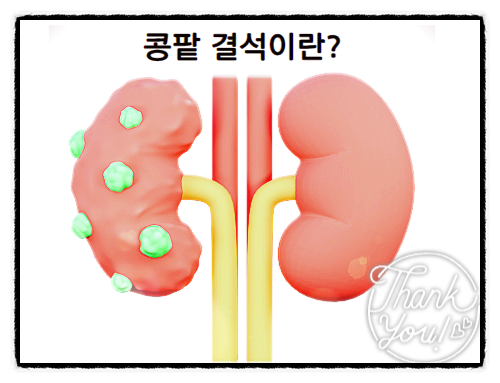  콩팥 결석 신장결석
