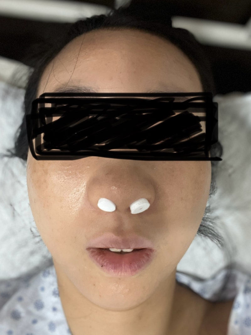 부비동염 수술 후기 -1