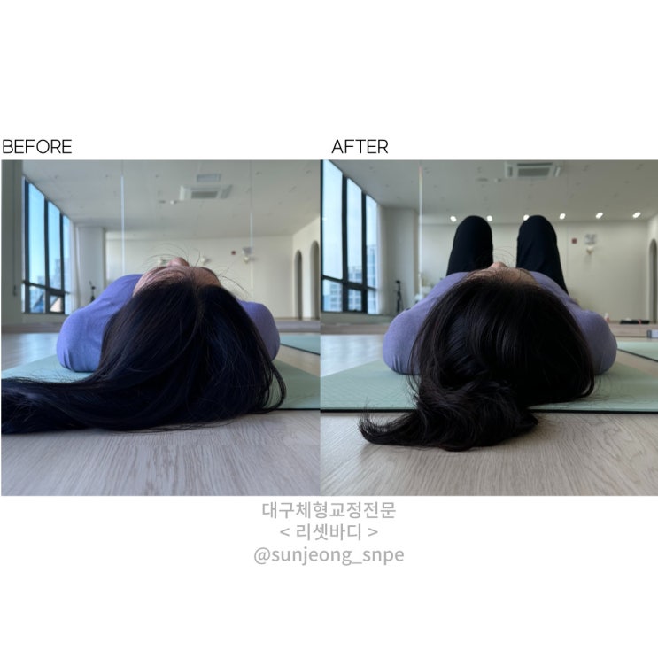  대구 SNPE 재활필라테스 목,허리 디스크+척추분리증 회원님 개선사례 집에서도 할 수 있는 허리 관리 운동