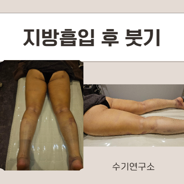  지방흡입 사후관리 회복을 돕는 10년 차 체형관리사의 조언