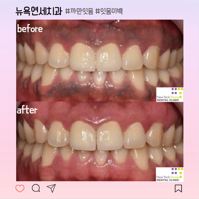  잇몸이 까매요, 검은 잇몸 미백으로 해결