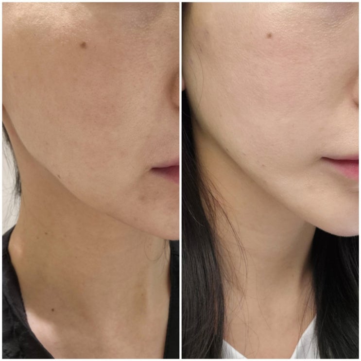  실리프팅 2주차 멍, 붓기X 전후 차이 대박 투명브이리프팅