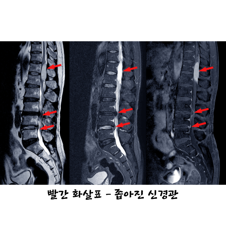  부산정형외과, 허리협착증 시술해도 오래 못 걷는 이유?