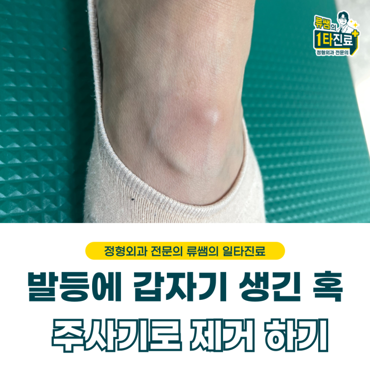  발등 혹, 주사기로 제거해도 재발합니다.  (의사작성)