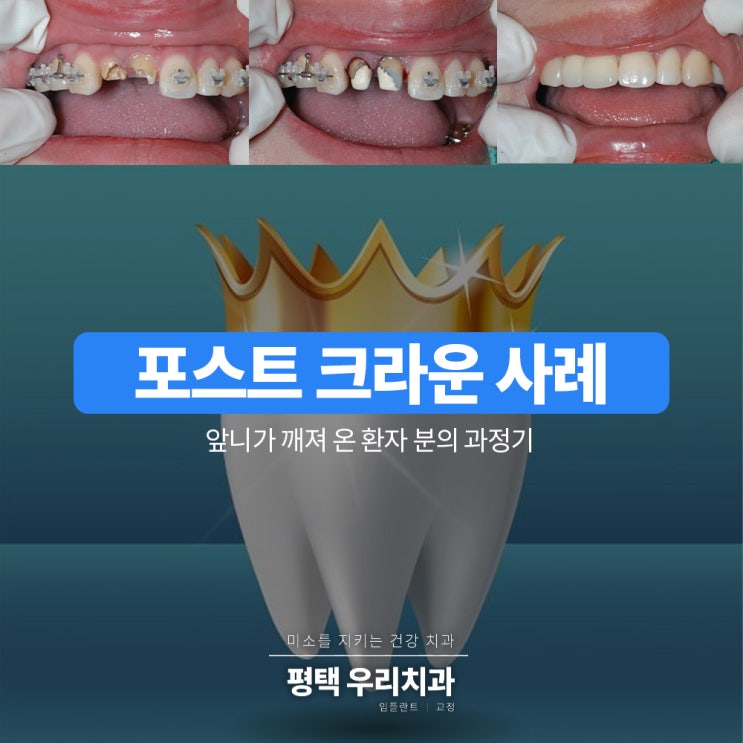  앞니 이빨깨짐 극복기: 포스트 크라운 평택치과 이빨깨짐치료 전후 비교