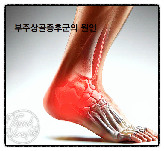  부주상골 증후군 예방하기