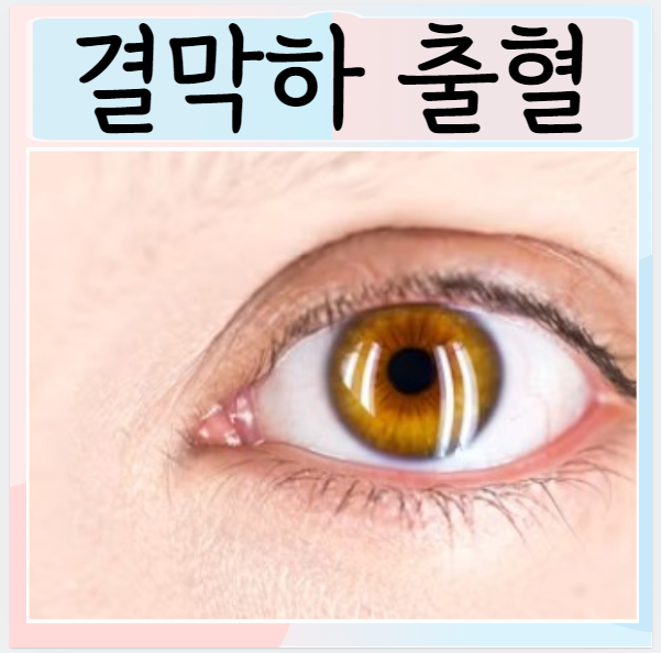  결막하 출혈 눈실핏줄 터짐 원인 증상 치료