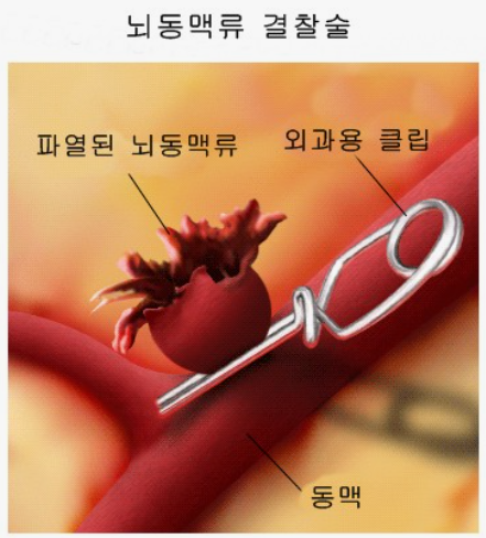 뇌동맥류 클립결찰술(Aneurysm clipping) 적응증,주의사항